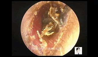 如何掏耳屎